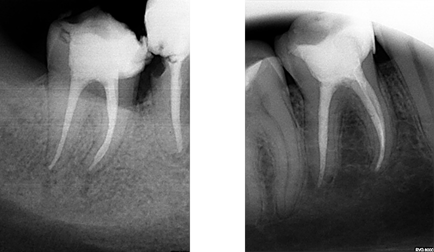 endodoncja rvg